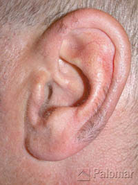 laser hair removal ear before