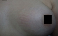 stretch mark after
